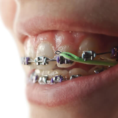 metal braces